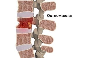 Перелом позвонка при остеопорозе
