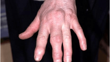 Боль в суставе среднего пальца левой руки лечение