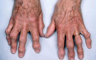 Боль в суставе среднего пальца левой руки лечение
