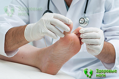 Лечение молоткообразных пальцев стопы должен назначить лечащий врач