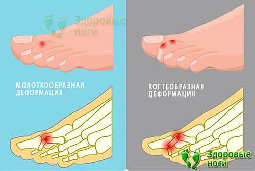 Когтеобразная деформация пальцев стопы характеризуется другой формой изгиба сустава